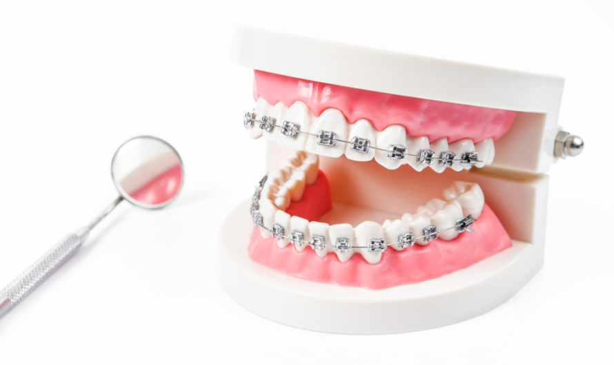 Traditional Metal Braces: Advantages and Cost