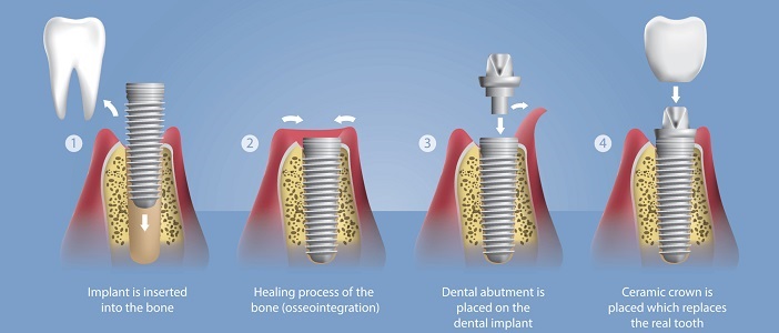 Dental Implants Treatment by Dr. Sonal Agrawal Best Dentist and Top Dental Specialist at Lotus Dental Care Clinic, Best Dental Clinic in Vashi, Navi Mumbai.