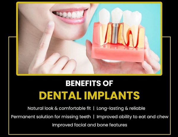 Benefits of Dental Implants