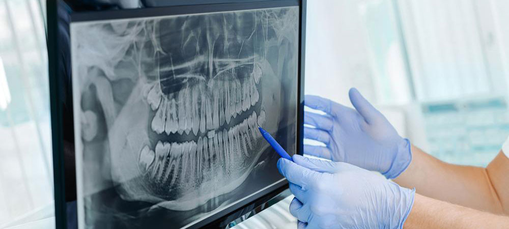 Dental Implants Treatment by Dr. Sonal Agrawal Best Dentist and Top Dental Specialist at Lotus Dental Care Clinic, Best Dental Clinic in Vashi, Navi Mumbai.