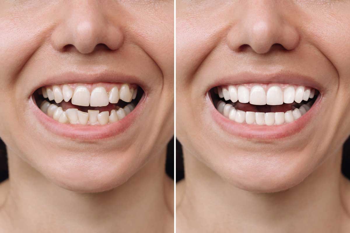>How Long Does Invisalign Treatment Take
