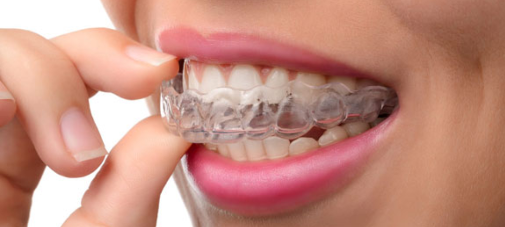 Invisalign Treatment by Dr. Sonal Agrawal, Best Dentist in Vashi, Navi Mumbai