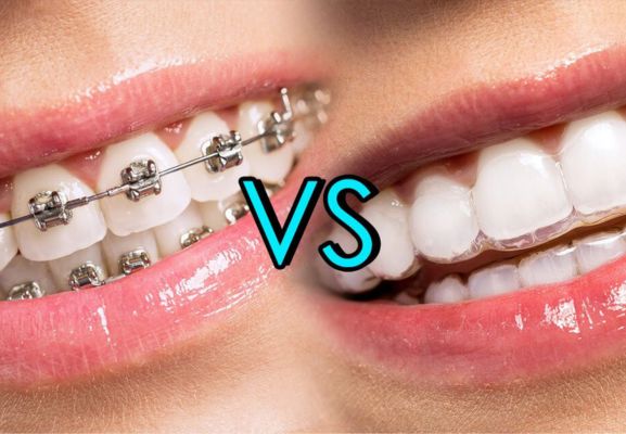 Why Choose Invisalign