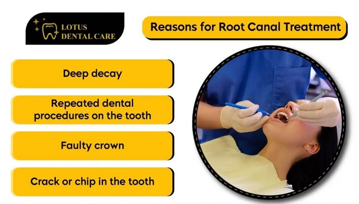 Advanced Root Canal Treatment service provided by Dr. Sonal Agrawal Best Dentist and Top Dental Specialist at Lotus Dental Care Clinic, Best Dental Clinic in Vashi, Navi Mumbai.