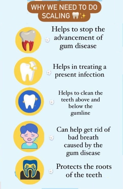 Teeth Scaling Treatment by Dr. Sonal Agrawal Best Dentist and Top Dental Specialist at Lotus Dental Care Clinic, Best Dental Clinic in Vashi, Navi Mumbai.