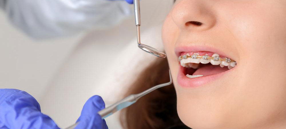 Orthodontic Braces Treatment provided by Dr. Sonal Agrawal Best Dentist and Top Dental Specialist at Lotus Dental Care Clinic, Best Dental Clinic in Vashi, Navi Mumbai.