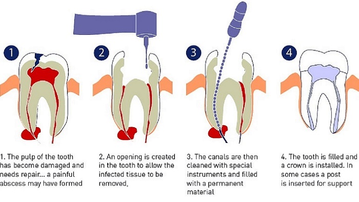 Root Canal Treatment service provided by Dr. Sonal Agrawal Best Dentist and Top Dental Specialist at Lotus Dental Care Clinic, Best Dental Clinic in Vashi, Navi Mumbai.