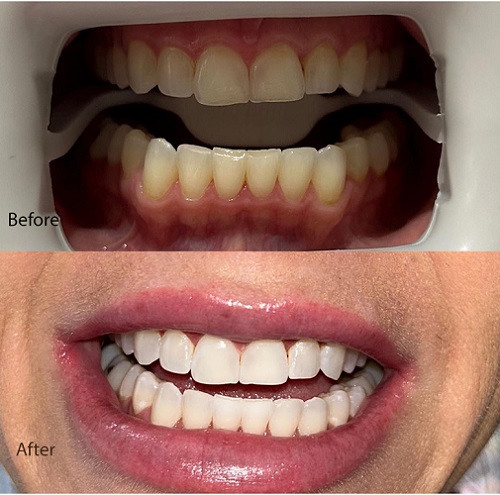 Before After image of Treatment of Teeth Whitening by Dr. Sonal Agrawal Best Dentist and Top Dental Specialist at Lotus Dental Care Clinic, Best Dental Clinic in Vashi, Navi Mumbai.