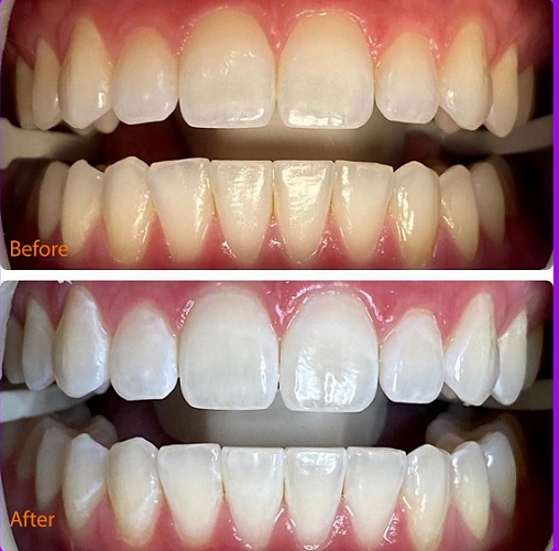 Teeth Whitening Treatment service provided by Dr. Sonal Agrawal Best Dentist and Top Dental Specialist at Lotus Dental Care Clinic, Best Dental Clinic in Vashi, Navi Mumbai.