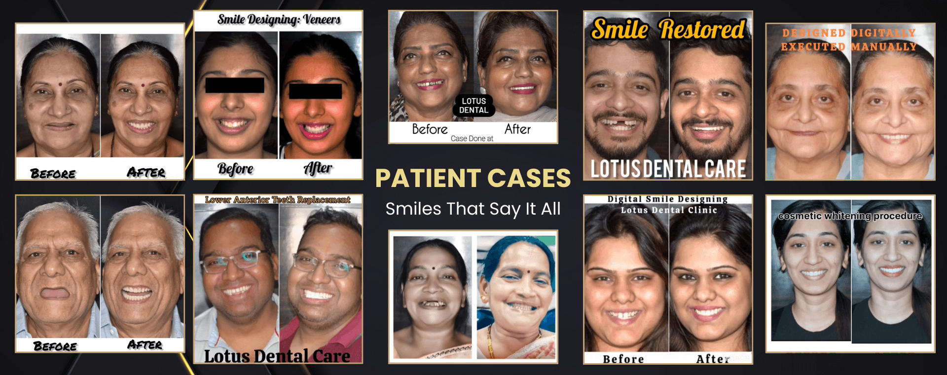 Dr. Sonal Agrawal offers best dental treatment for TEETH WHITENING TREATMENT, DIGITAL SMILE DESIGN, SMILE MAKEOVER in Vashi, Navi Mumbai.